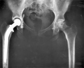 Total hip replacement surgery has become a common procedure. The head (or ball) of the patient's femur fits into a cup that has a hard plastic-like inner lining.
